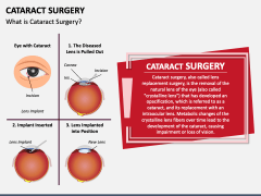 Cataract Surgery Powerpoint And Google Slides Template Ppt Slides