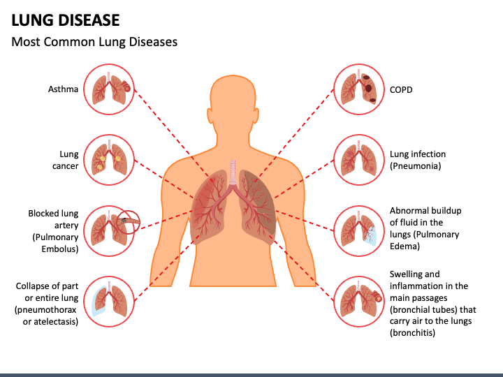Lung Disease Powerpoint Template Ppt Slides