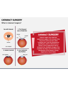 Cataract Surgery PPT Slide 1
