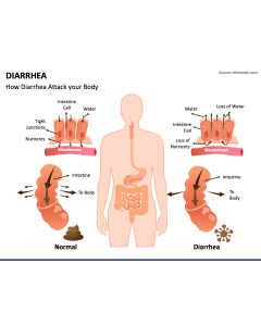 Diarrhea PPT Slide 1