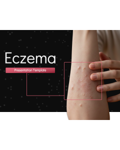 Eczema PPT Thumbnail