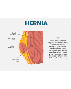 Hernia PPT Slide 1