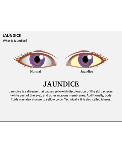 Jaundice PPT Slide 1
