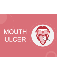 Mouth Ulcer PPT Thumbnail