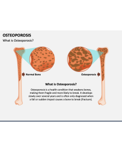 Osteoporosis PPT Slide 1