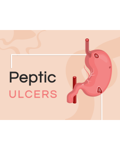Peptic Ulcers PPT Thumbnail