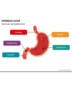 Stomach Ulcer PPT Slide 1