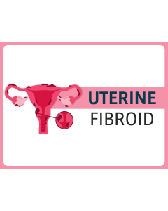 Uterine Fibroid PPT Thumbnail