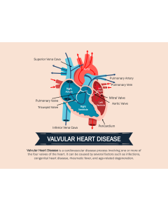 Valvular Heart Disease PPT Slide 1