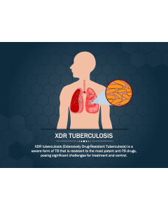 XDR Tuberculosis PPT Slide 1