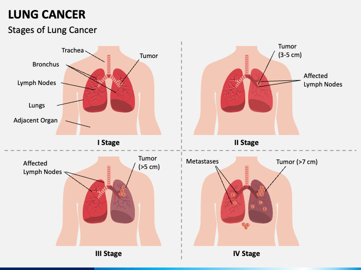 Lung Cancer PPT Slide 1