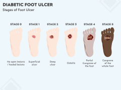 Diabetic Foot Ulcer PowerPoint Template and Google Slides Theme