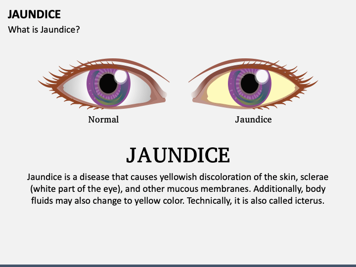 jaundice slide presentation