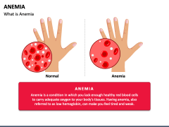 Free Anemia PowerPoint and Google Slides Template - PPT Slides