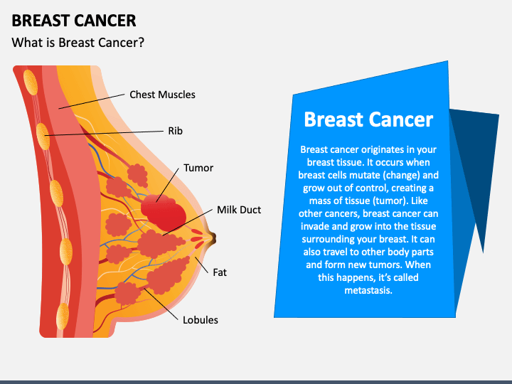 Breast Cancer PPT Slide 1