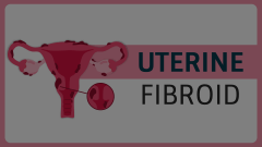 Uterine Fibroid Animated Presentation - SketchBubble