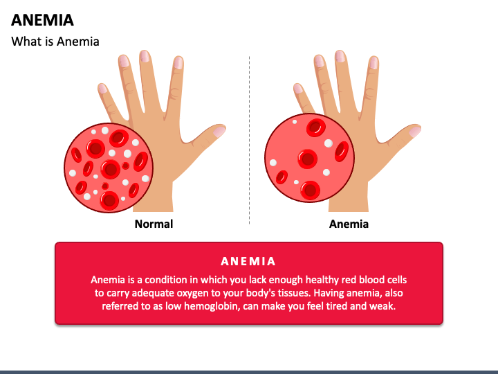 Anemia PowerPoint Template - PPT Slides