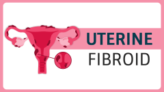 Uterine Fibroid PPT Slide 1