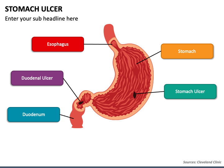 Stomach Ulcer PPT Slide 1