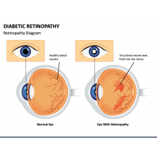 Diabetic Neuropathy PowerPoint Template and Google Slides Theme