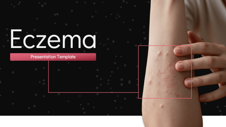 Eczema PPT Slide 1