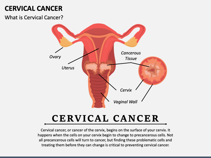 Cervical Cancer PPT Slide 1