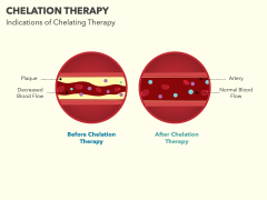 Chelation Therapy PowerPoint And Google Slides Template - PPT Slides