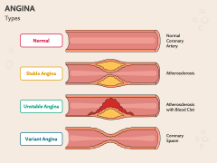 Angina PowerPoint Template and Google Slides Theme